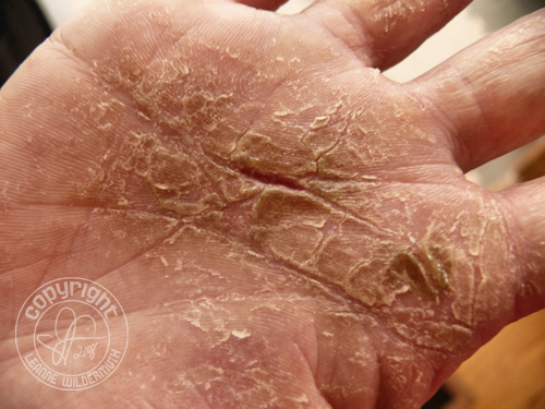 macro photo skin hands cracked fungus disease
